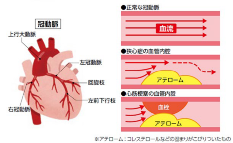 冠動脈の動脈硬化にともなう狭心症